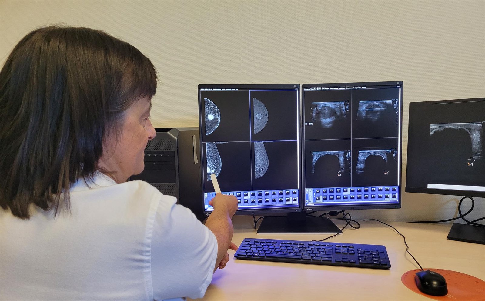 El Infanta Leonor incorpora la crioablación para tratar el cáncer de mama